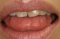 舌尖部の歯痕